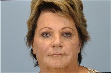 Dermal Fillers After Photo by Paul Vanek, MD, FACS; Concord, OH - Case 34023