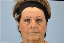 Dermal Fillers Before Photo by Paul Vanek, MD, FACS; Concord, OH - Case 34023