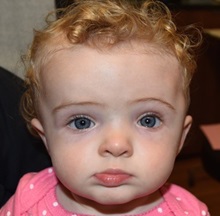 Craniosynostosis After Photo by Rachel Ruotolo, MD; Garden City, NY - Case 34151