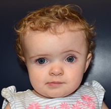 Craniosynostosis Before Photo by Rachel Ruotolo, MD; Garden City, NY - Case 34151
