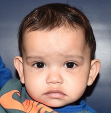 Craniosynostosis After Photo by Rachel Ruotolo, MD; Garden City, NY - Case 34152