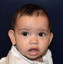 Craniosynostosis Before Photo by Rachel Ruotolo, MD; Garden City, NY - Case 34152