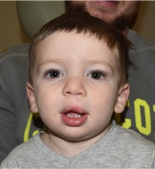 Cleft Lip and Palate Repair After Photo by Rachel Ruotolo, MD; Garden City, NY - Case 34167
