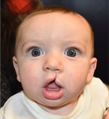 Cleft Lip and Palate Repair Before Photo by Rachel Ruotolo, MD; Garden City, NY - Case 34167