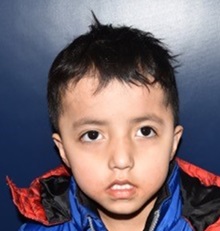 Craniosynostosis After Photo by Rachel Ruotolo, MD; Garden City, NY - Case 34206
