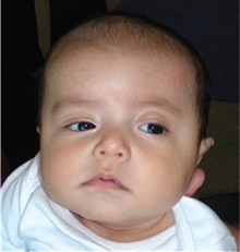 Craniosynostosis Before Photo by Rachel Ruotolo, MD; Garden City, NY - Case 34206