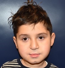 Cleft Lip and Palate Repair After Photo by Rachel Ruotolo, MD; Garden City, NY - Case 34210