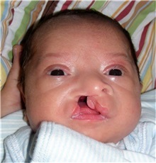 Cleft Lip and Palate Repair Before Photo by Rachel Ruotolo, MD; Garden City, NY - Case 34210