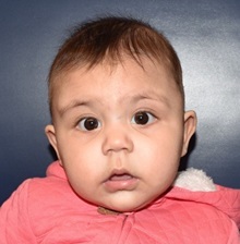 Craniosynostosis After Photo by Rachel Ruotolo, MD; Garden City, NY - Case 34219