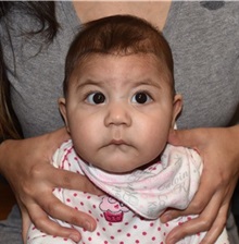 Craniosynostosis Before Photo by Rachel Ruotolo, MD; Garden City, NY - Case 34219