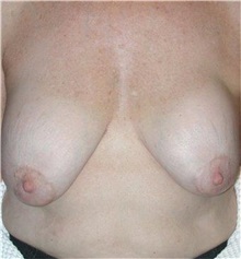 Breast Reduction Before Photo by Frederick Lukash, MD, FACS, FAAP; East Hills, NY - Case 35070