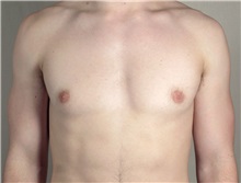 Male Breast Reduction After Photo by Paul Parker, MD; Paramus, NJ - Case 35101