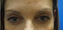 Eyelid Surgery After Photo by Niki Christopoulos, MD, FACS; Chicago, IL - Case 35275