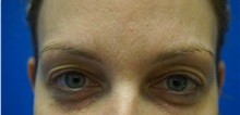 Eyelid Surgery Before Photo by Niki Christopoulos, MD, FACS; Chicago, IL - Case 35275