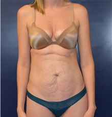 Liposuction Before Photo by Richard Reish, MD, FACS; New York, NY - Case 35293