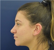 Rhinoplasty After Photo by Richard Reish, MD, FACS; New York, NY - Case 35395