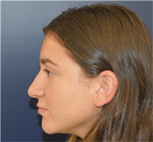 Rhinoplasty Before Photo by Richard Reish, MD, FACS; New York, NY - Case 35395