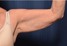 Arm Lift Before Photo by Michael Frederick, MD; Fort Lauderdale, FL - Case 35883