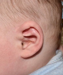 Ear Surgery After Photo by Rachel Ruotolo, MD; Garden City, NY - Case 36167
