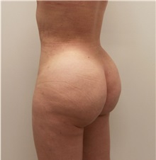 Buttock Lift with Augmentation After Photo by Ravi Somayazula, DO; Houston, TX - Case 36629