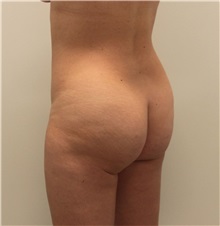 Buttock Lift with Augmentation Before Photo by Ravi Somayazula, DO; Houston, TX - Case 36629