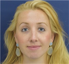 Rhinoplasty After Photo by Richard Reish, MD, FACS; New York, NY - Case 36720