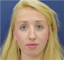Rhinoplasty Before Photo by Richard Reish, MD, FACS; New York, NY - Case 36720