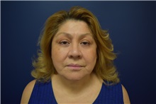 Facelift After Photo by Michael Dobryansky, MD, FACS; Garden City, NY - Case 36745