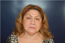 Facelift Before Photo by Michael Dobryansky, MD, FACS; Garden City, NY - Case 36745