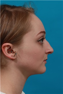 Rhinoplasty Before Photo by Michael Bogdan, MD, MBA, FACS; Grapevine, TX - Case 36907