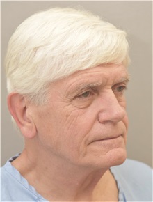Facelift Before Photo by Keshav Magge, MD; Bethesda, MD - Case 37002