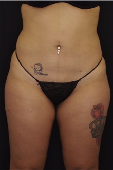 Body Contouring After Photo by Landon Pryor, MD, FACS; Rockford, IL - Case 37702