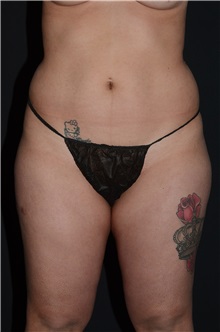 Body Contouring Before Photo by Landon Pryor, MD, FACS; Rockford, IL - Case 37702