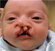 Cleft Lip and Palate Repair Before Photo by Rachel Ruotolo, MD; Garden City, NY - Case 38039