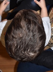 Craniosynostosis After Photo by Rachel Ruotolo, MD; Garden City, NY - Case 38120