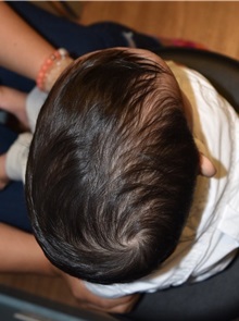 Craniosynostosis Before Photo by Rachel Ruotolo, MD; Garden City, NY - Case 38120