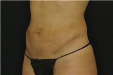 Liposuction After Photo by Landon Pryor, MD, FACS; Rockford, IL - Case 38149