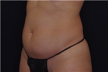 Liposuction Before Photo by Landon Pryor, MD, FACS; Rockford, IL - Case 38149