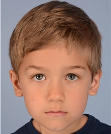 Ear Surgery After Photo by Christopher Derderian, MD; Dallas, TX - Case 38272