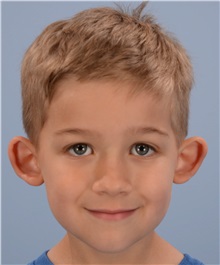 Ear Surgery Before Photo by Christopher Derderian, MD; Dallas, TX - Case 38272