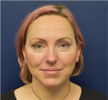 Chin Augmentation After Photo by Richard Reish, MD, FACS; New York, NY - Case 38327