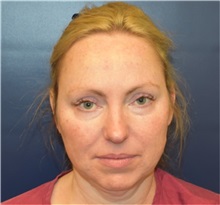 Chin Augmentation Before Photo by Richard Reish, MD, FACS; New York, NY - Case 38327