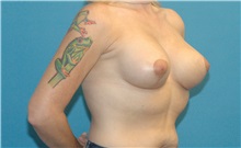 Breast Lift After Photo by Scott Sattler, MD,  FACS; Seattle, WA - Case 38602