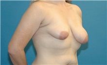 Breast Lift Before Photo by Scott Sattler, MD,  FACS; Seattle, WA - Case 38602