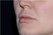 Lip Augmentation/Enhancement After Photo by Landon Pryor, MD, FACS; Rockford, IL - Case 38764