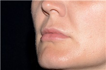 Lip Augmentation/Enhancement Before Photo by Landon Pryor, MD, FACS; Rockford, IL - Case 38764
