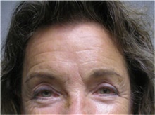 Brow Lift Before Photo by Mariam Awada, MD, FACS; Southfield, MI - Case 38881