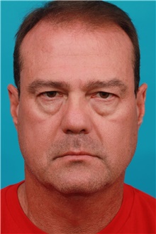 Eyelid Surgery Before Photo by Michael Bogdan, MD, MBA, FACS; Grapevine, TX - Case 39208