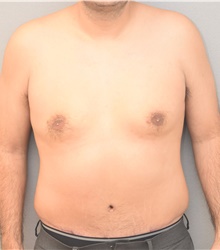 Tummy Tuck After Photo by Keshav Magge, MD; Bethesda, MD - Case 39544