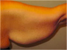 Arm Lift Before Photo by Mariam Awada, MD, FACS; Southfield, MI - Case 40214